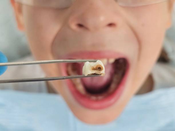 Best Emergency Treatment for Oral Infections in Richmond West, FL